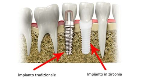  Ossido di Zirconia: Materiale Avanzato per l'Impianto Dentale e le Turbine ad Alta Velocità!